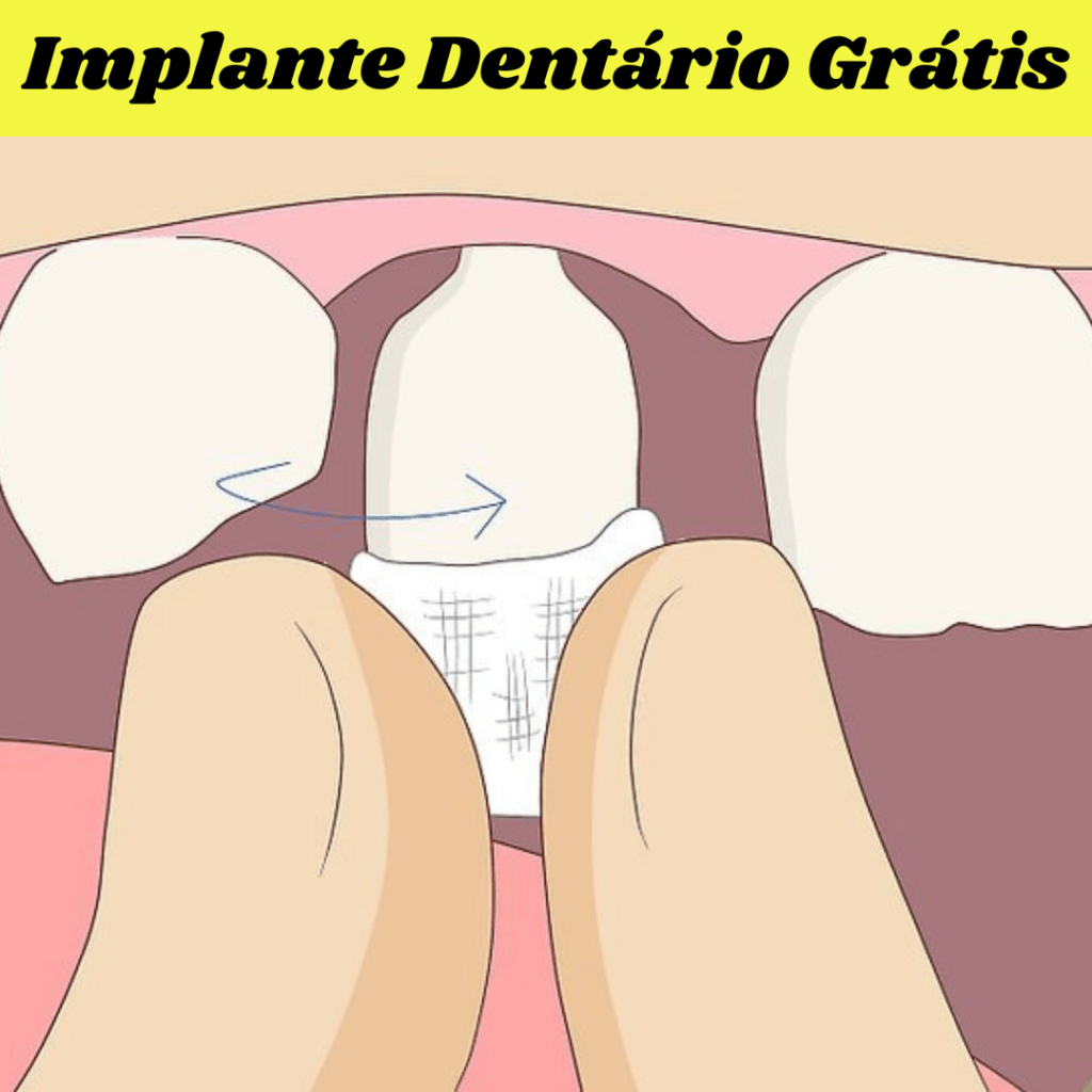 Quais Valores de Implantes Dentários de Titânio e de Cerâmica?