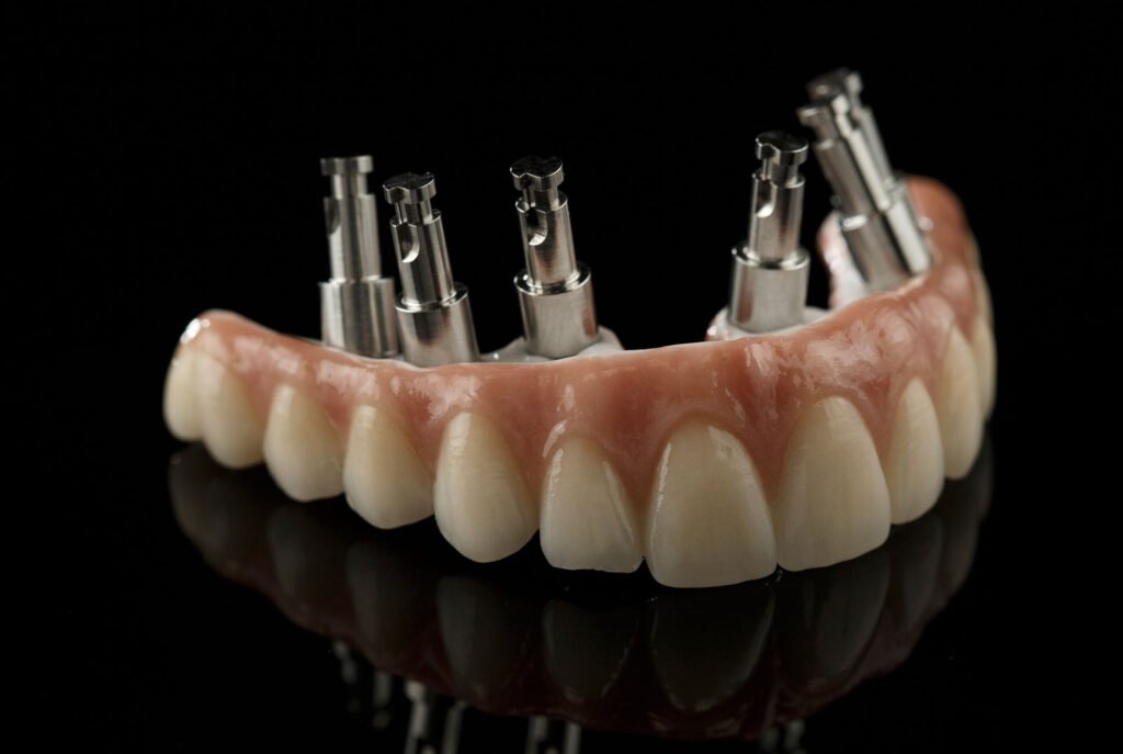 Recupere Seu Sorriso: Descubra Como o Implante Dentário Pode Transformar Sua Vida!